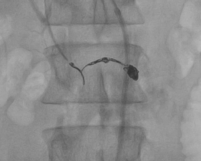GI bleed post coiling