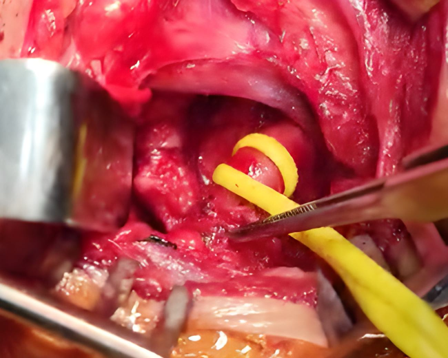 Intraoperative photo of rib compressing the artery
