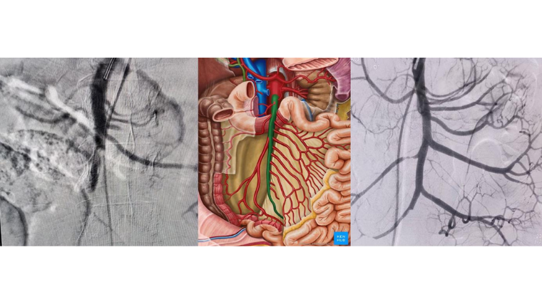 Mesenteric / Bowel Ischaemia