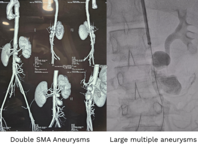Mesenteric or GI bleed