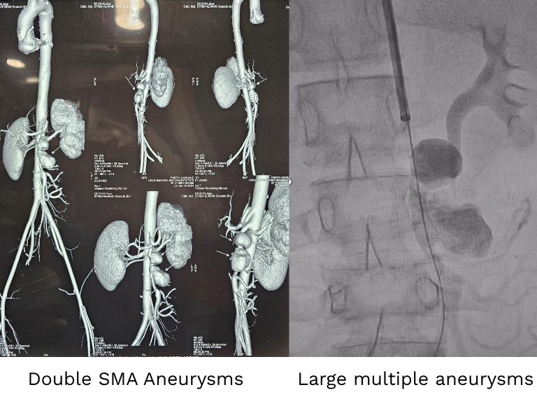 Mesenteric or GI bleed
