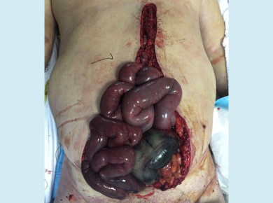Mesenteric / Bowel Ischaemia