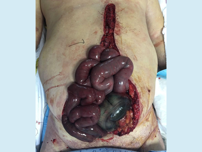 Mesenteric ischaemia