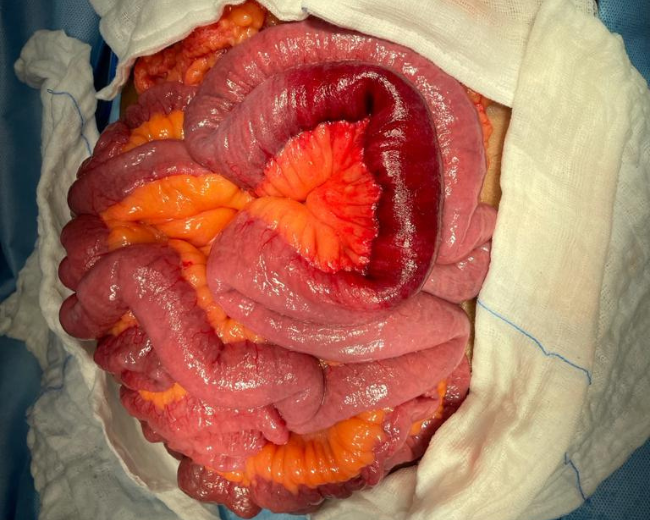 Mesenteric Ischaemia