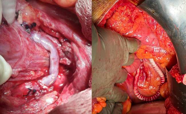 Mesenteric Ischaemia