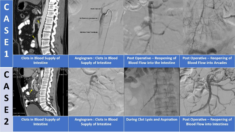 Mesenteric / Bowel Ischaemia