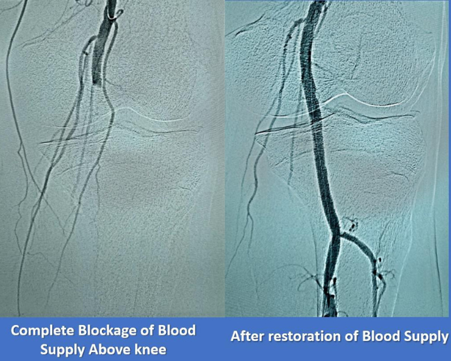 Peripheral Arterial Disease And Diabetic Foot