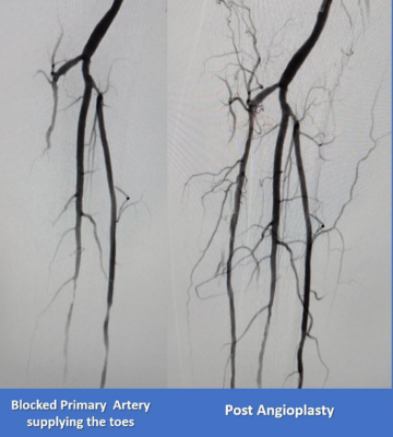 Peripheral Arterial Disease And Diabetic Foot