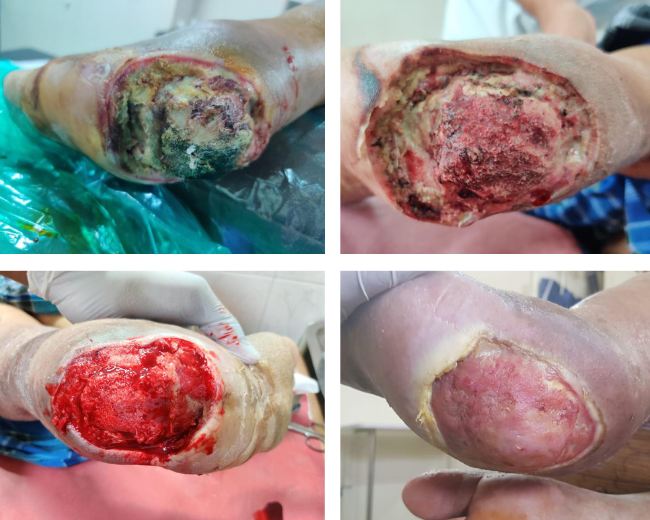Peripheral Arterial Disease and Diabetic Foot
