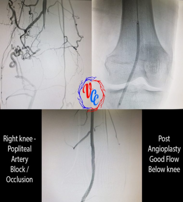 Popliteal artery angioplasty