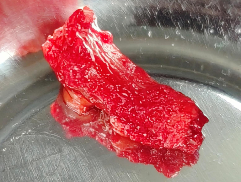 Post excision of cervical rib