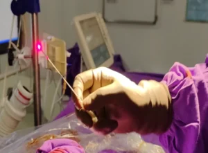 Laser fibre being prepared for endovenous laser ablation of a varicose vein