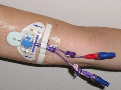 Vascular Access for Chemotherapy