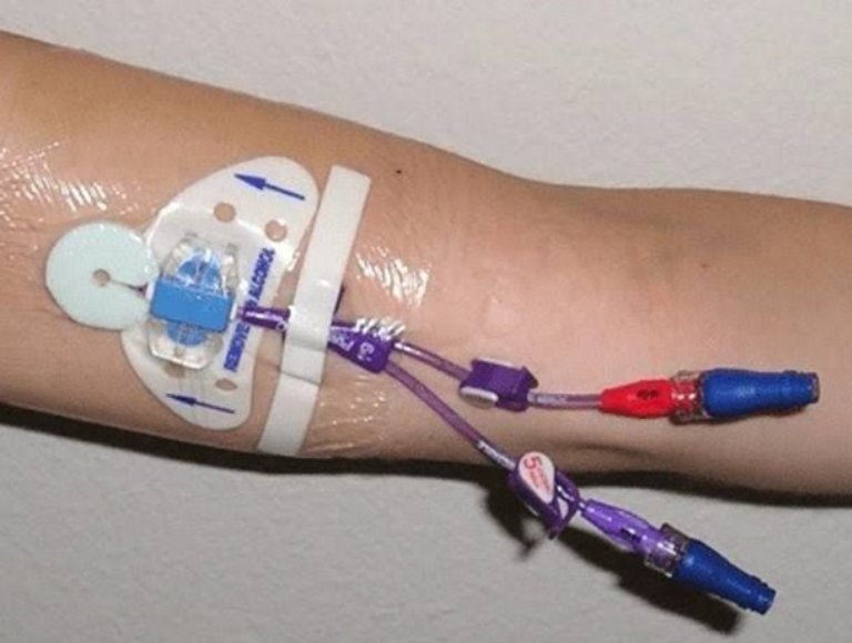 Vascular Access for Chemotherapy