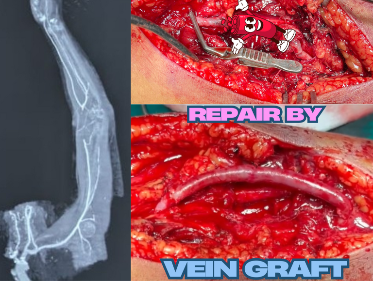 Vascular Trauma