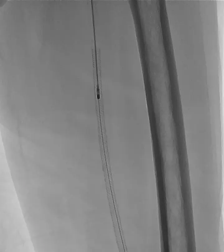 X-ray of atherectomy inside an occluded stent in the thigh artery