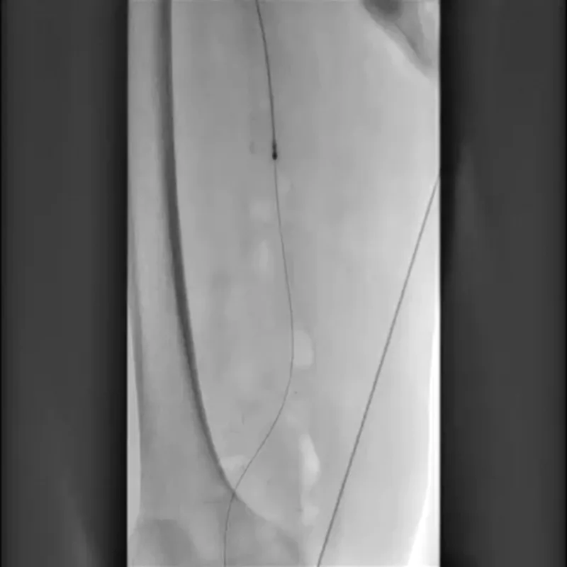 X-ray during atherectomy showing the device tip on a guidewire inside an artery