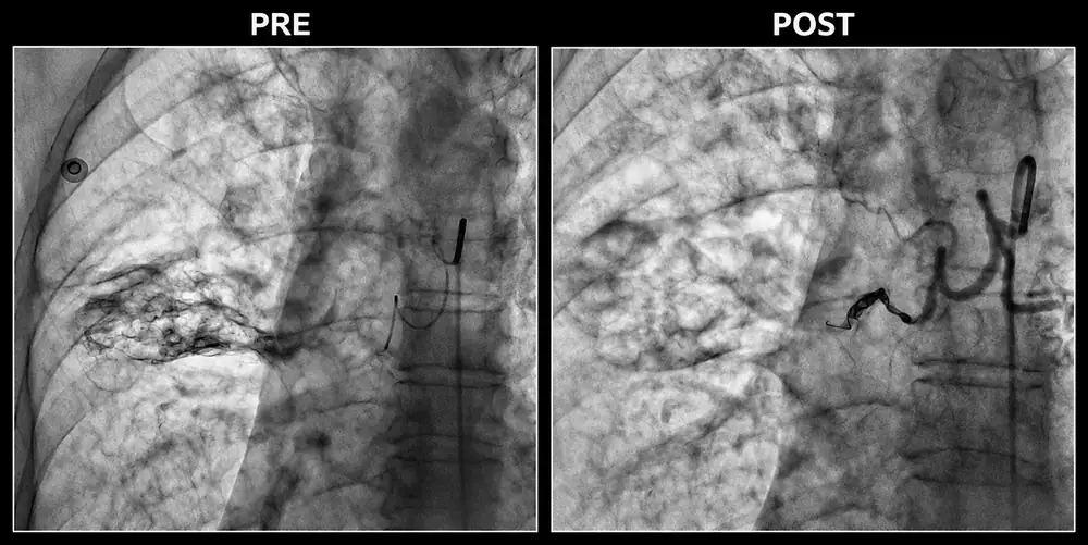 Bronchial artery angiogram before and after bronchial artery embolisation for massive hemoptysis