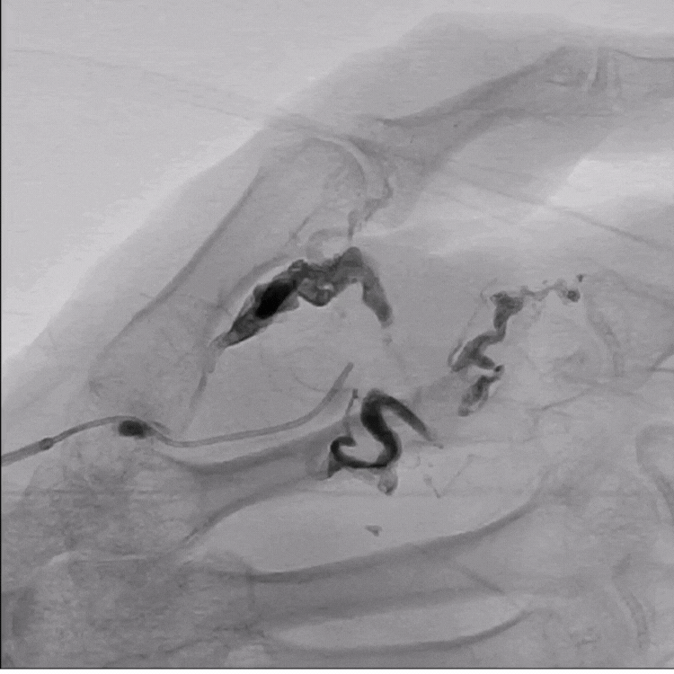 Vascular Malformation X-ray